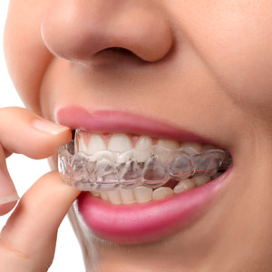 Clear Aligners