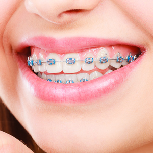 Braces